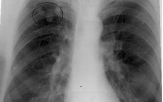 Развитие и опасность туберкуломы легкого