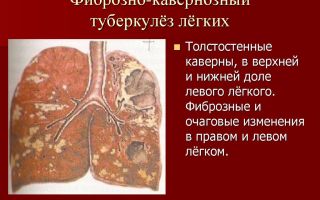 Развитие фиброзно-кавернозной формы туберкулеза