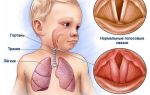 Признаки и терапия аллергического трахеита у детей и взрослых
