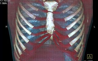 Обследование органов грудной клетки посредством компьютерной томографии