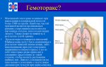 Гемоторакс: причины и лечение
