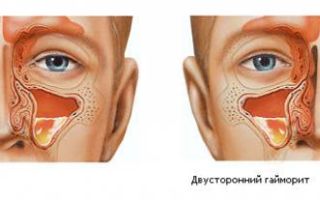 Использование перекиси водорода при болезнях носа
