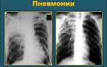 Как отличить туберкулез от пневмонии?
