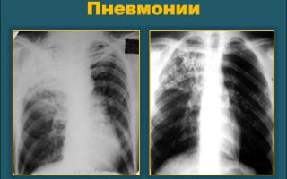 Как отличить туберкулез от пневмонии?