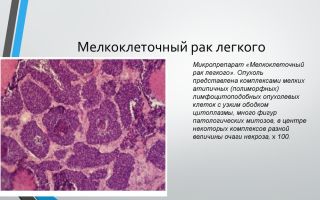 Особенности мелкоклеточного рака легких