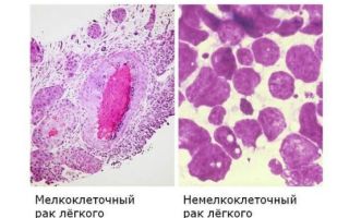 Особенности немелкоклеточного рака легких