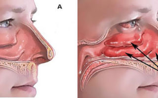 Симптомы и терапия отека слизистой носа у ребенка