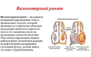 Особенности вазомоторного ринита и его лечение