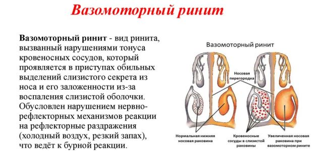 Особенности вазомоторного ринита и его лечение