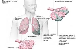 Базальный пневмосклероз: причины, симптомы, лечение