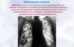 Природа и особенности развития туберкулеза легких