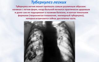 Природа и особенности развития туберкулеза легких