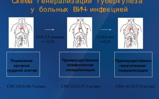 Развитие туберкулеза на фоне спида