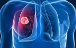 Температура при онкологии легких: какая она бывает и почему возникает?