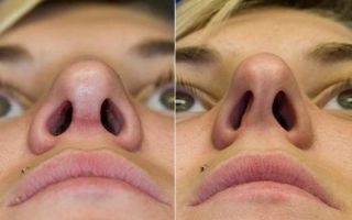 Лазерная хирургия: исправление перегородки носа безболезненным способом