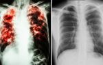 Опасна ли закрытая форма легочного туберкулеза?