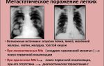 Ограничения при туберкулезе легких