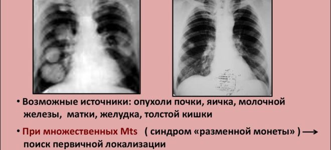 Ограничения при туберкулезе легких