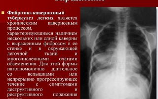 Особенности симптомов и лечения кавернозного туберкулеза