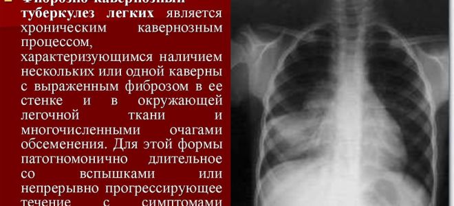 Особенности симптомов и лечения кавернозного туберкулеза