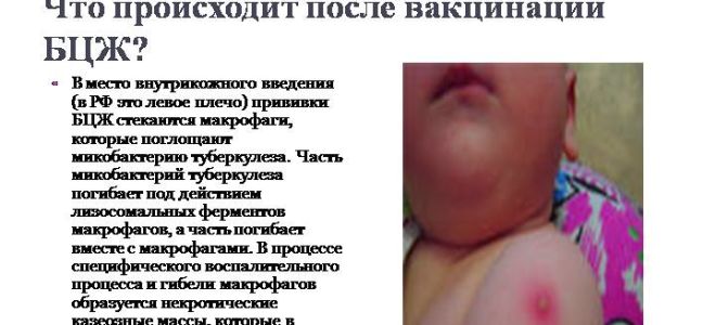 Что называется виражем манту?