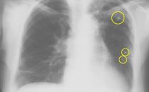 Определение туберкулеза легких на флюорографии
