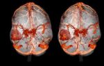 Метастазы в головной мозг при раке легких: особенности и возможности выздоровления