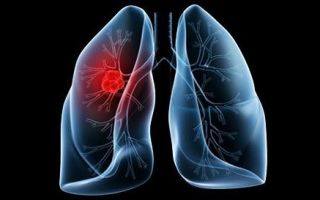 Особенности и методы лечения казеозной пневмонии