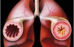 Медикаментозное лечение астмы: какие препараты применять?