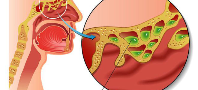 Что такое гайморовы пазухи и почему они могут воспалиться?
