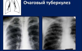 Очаговая форма туберкулеза легких