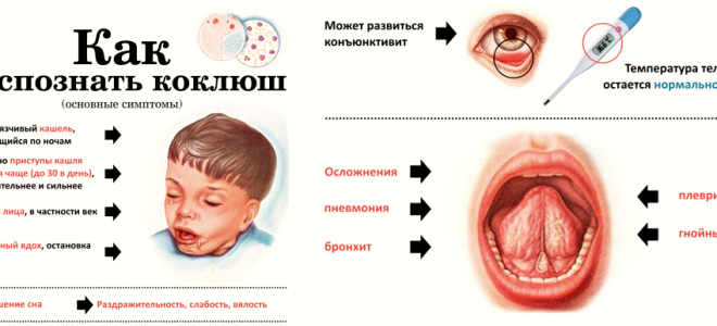 Как проявляется коклюш у взрослых?