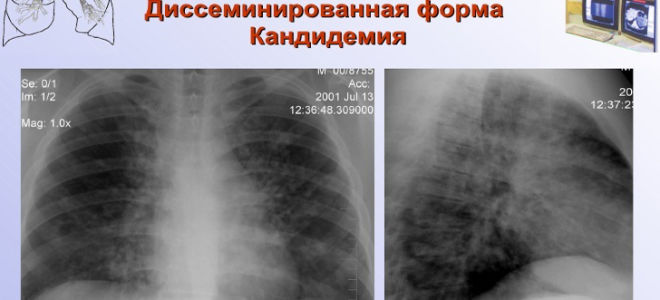 Грибок бронхов и кандидоз легких: как лечить поражение?