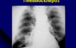 Пневмосклероз легких: причины и способы лечения