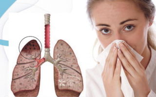 Взаимосвязь и отличия туберкулеза и онкологии легких
