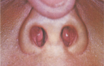 Развитие и терапия фурункула в носу