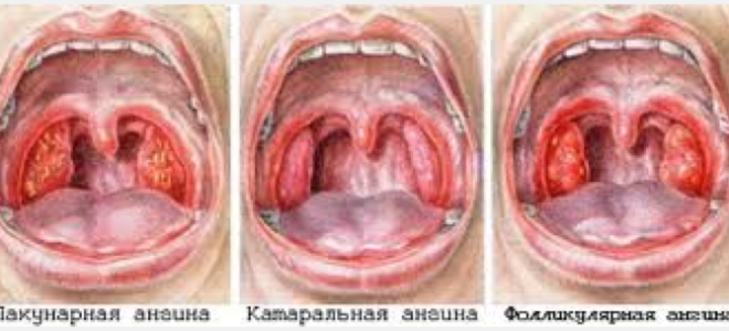 Виды и лечение кашля при ангине: особенности проявления симптома