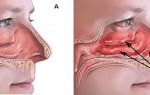 Развитие сухости слизистой в носу и методы ее лечения