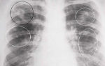 К каким осложнениям может привести бронхиальная астма?