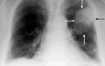 Флюорография при раке легких: покажет ли патологию?