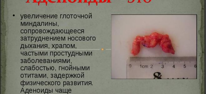 Увеличение аденоидных разрастаний у ребенка