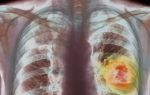 Рак легких у женщин – клиническая картина на разных стадиях заболевания