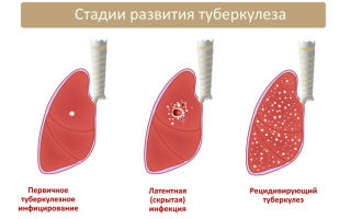 Все о начальной стадии развития туберкулеза