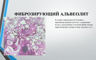 Фиброзирующий альвеолит: причины, диагностика и лечение