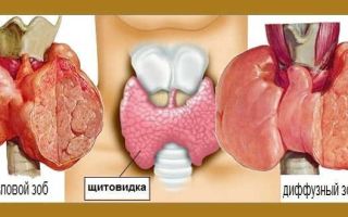 Кашель при щитовидке: этиология, симптомы, методы борьбы
