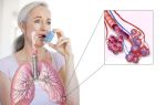 Как диагностировать бронхиальную астму?