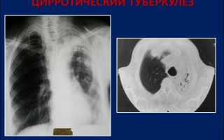 Причины, симптомы и терапия цирротического туберкулеза