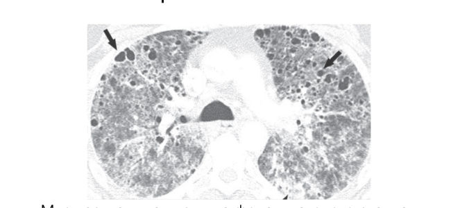 Пневмоцистоз – маркер вич-инфекции