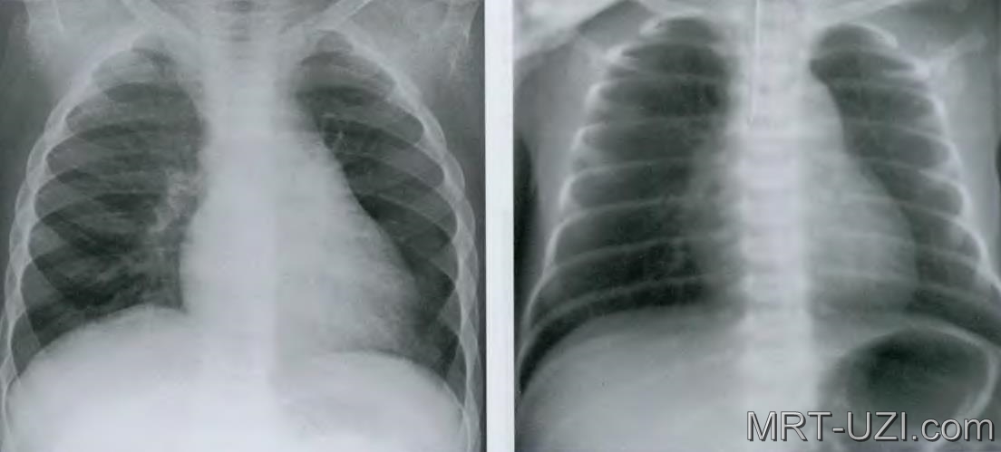 1 легкое меньше другого. Рентген грудной клетки норма. Рентген грудной клетки и флюорография. Рентгенография грудной клетки ребенка в норме. Рентген органов грудной клетки и флюорография разница.