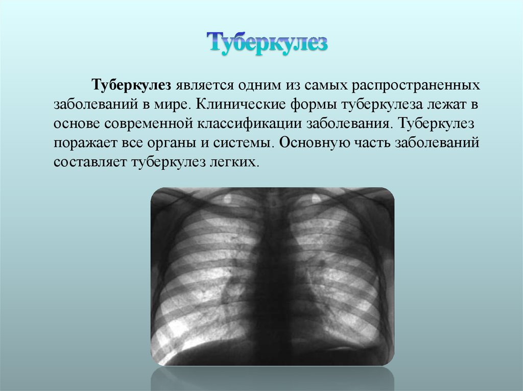 1 туберкулез это. Туберкулез легких презентация. Туберкулёз открытой формы. Открытые формы туберкулеза.